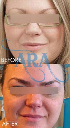 Eyebrow Threading (Before and After)